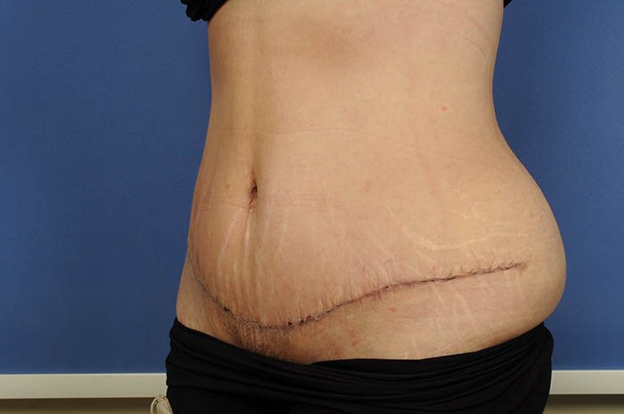 Tummy Tuck Before & After Image