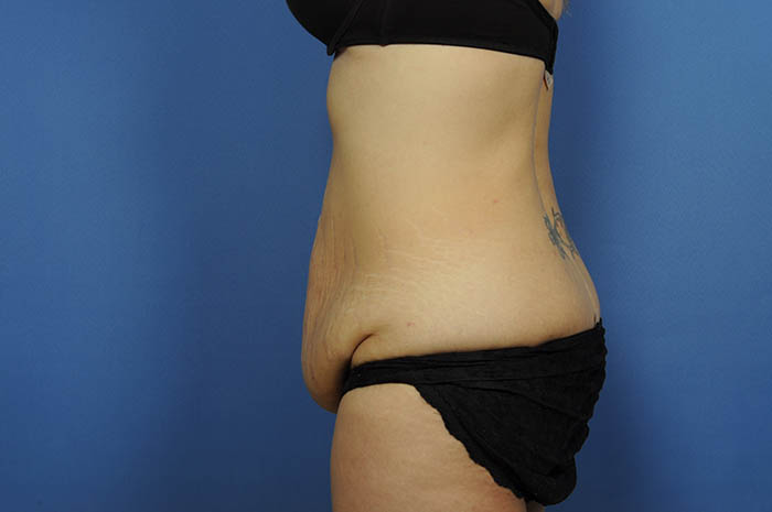 Tummy Tuck Before & After Image