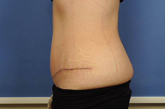 Tummy Tuck Before & After Image