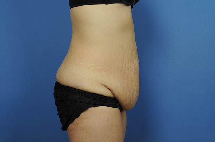 Tummy Tuck Before & After Image