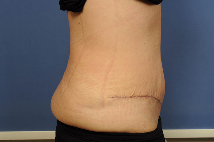 Tummy Tuck Before & After Image