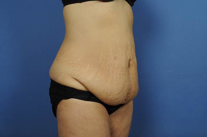 Tummy Tuck Before & After Image