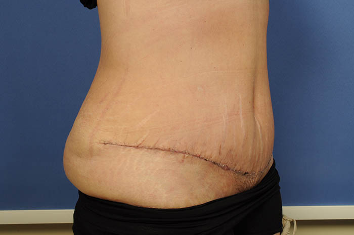 Tummy Tuck Before & After Image