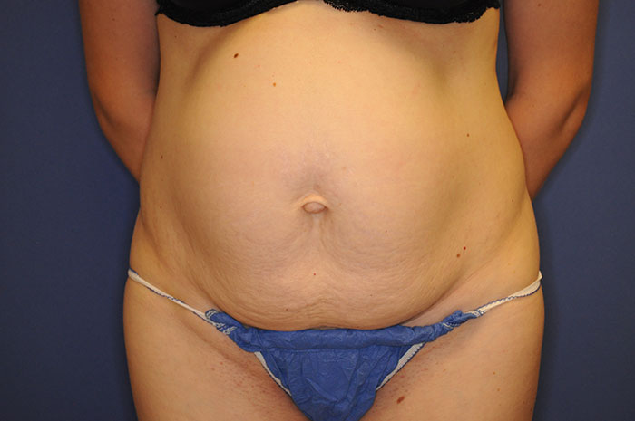 Tummy Tuck Before & After Image