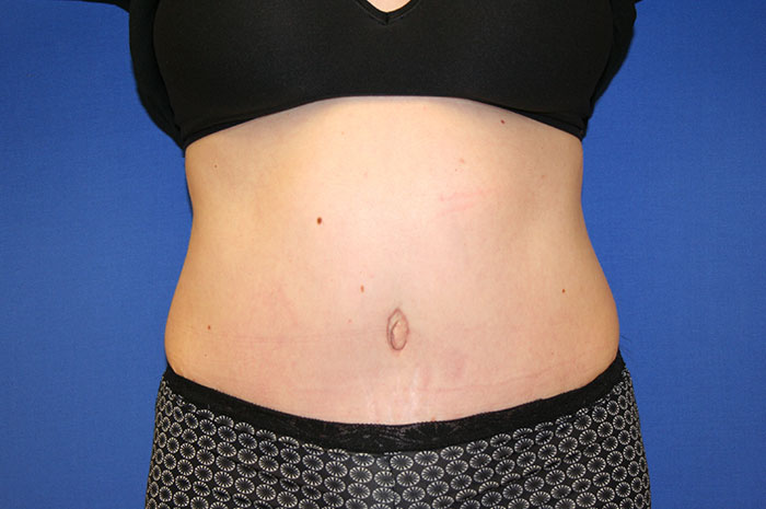 Tummy Tuck Before & After Image