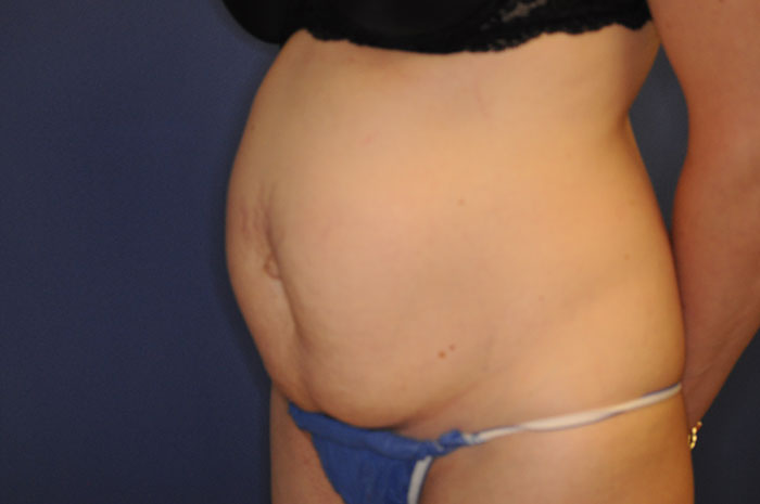 Tummy Tuck Before & After Image