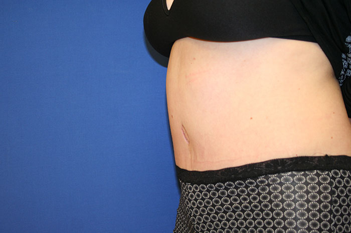 Tummy Tuck Before & After Image