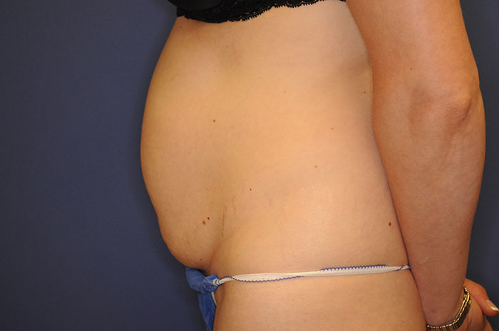 Tummy Tuck Before & After Image