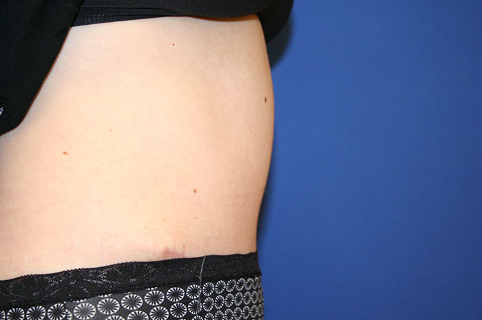 Tummy Tuck Before & After Image