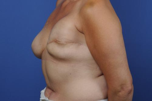 Breast Reconstruction Revision Before & After Image