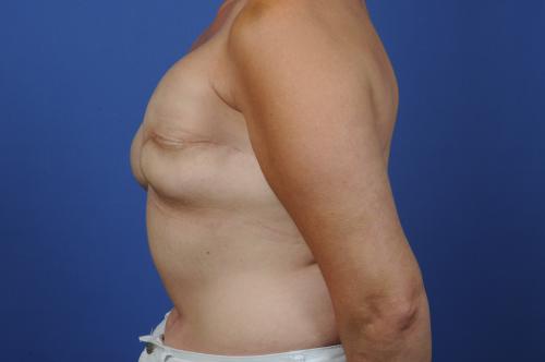 Breast Reconstruction Revision Before & After Image