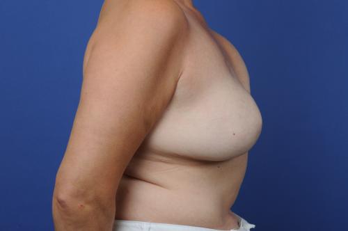 Breast Reconstruction Revision Before & After Image