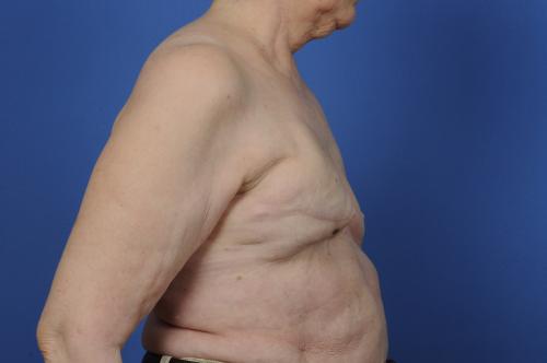 Delayed Breast Reconstruction Before & After Image