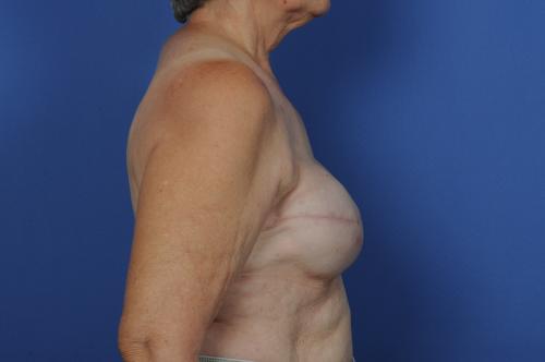 Delayed Breast Reconstruction Before & After Image