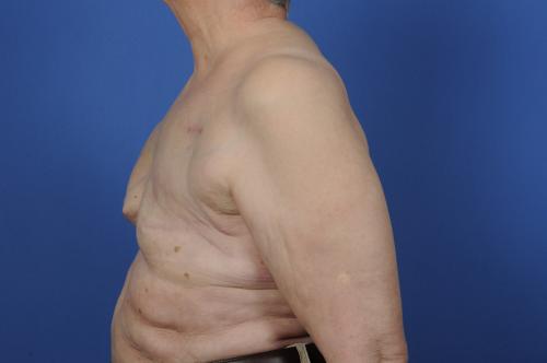 Delayed Breast Reconstruction Before & After Image