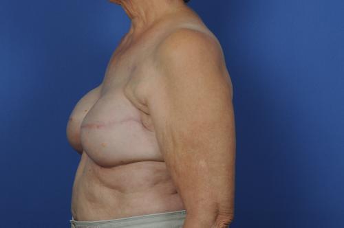 Delayed Breast Reconstruction Before & After Image