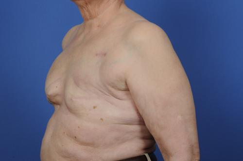 Delayed Breast Reconstruction Before & After Image