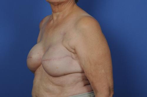 Delayed Breast Reconstruction Before & After Image