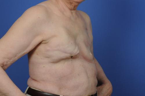 Delayed Breast Reconstruction Before & After Image