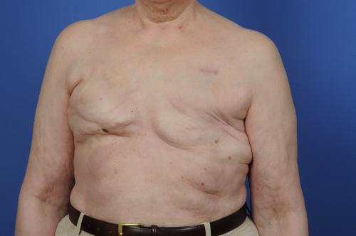 Delayed Breast Reconstruction Before & After Image