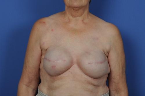 Delayed Breast Reconstruction Before & After Image