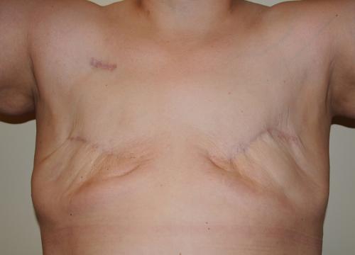 Delayed Breast Reconstruction Before & After Image