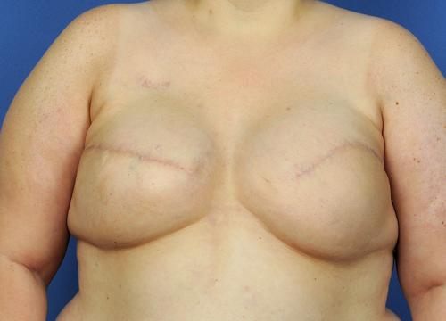 Delayed Breast Reconstruction Before & After Image