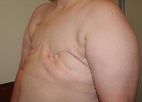 Delayed Breast Reconstruction Before & After Image