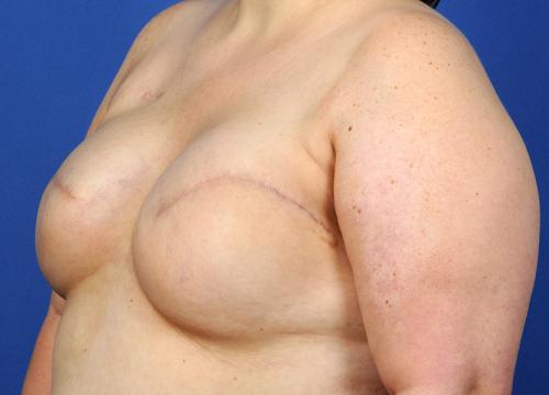 Delayed Breast Reconstruction Before & After Image