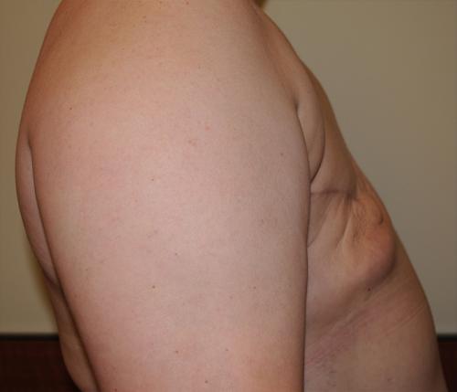 Delayed Breast Reconstruction Before & After Image