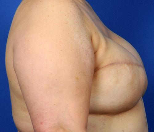 Delayed Breast Reconstruction Before & After Image