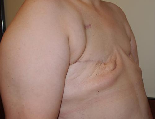 Delayed Breast Reconstruction Before & After Image