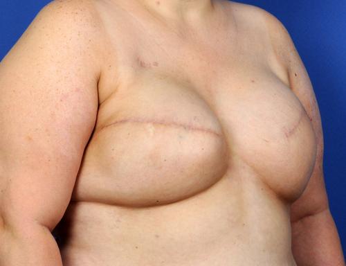 Delayed Breast Reconstruction Before & After Image