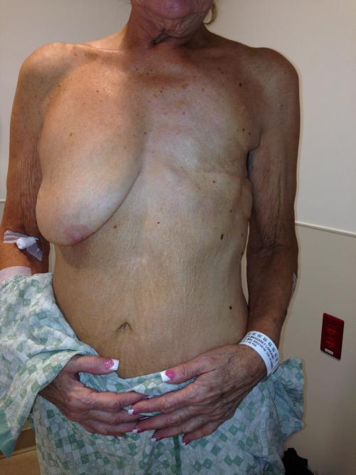 Latissimus Dorsi Flap Before & After Image