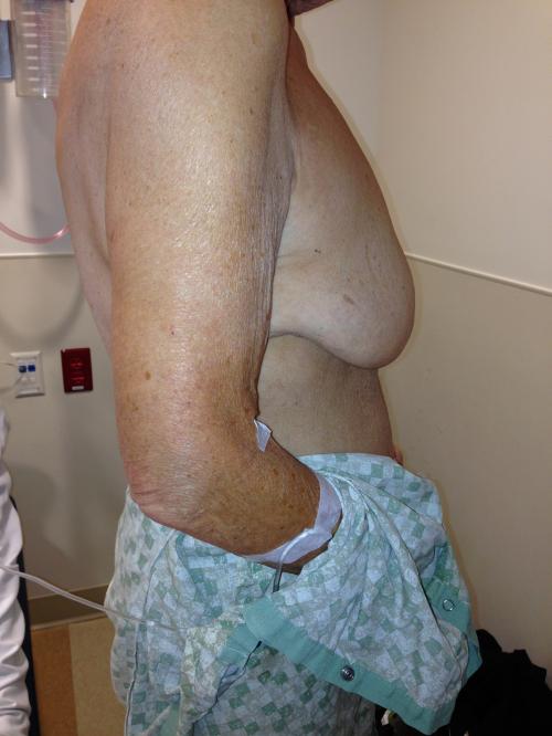 Latissimus Dorsi Flap Before & After Image