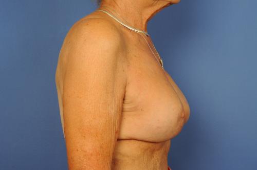 Latissimus Dorsi Flap Before & After Image