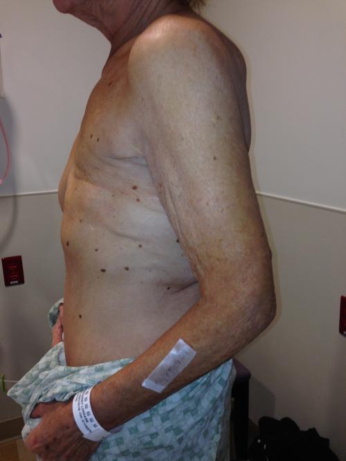 Latissimus Dorsi Flap Before & After Image