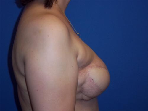 Latissimus Dorsi Flap Before & After Image