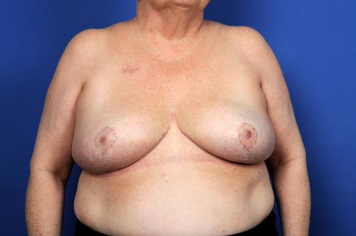 Lumpectomy Breast Reduction Before & After Image