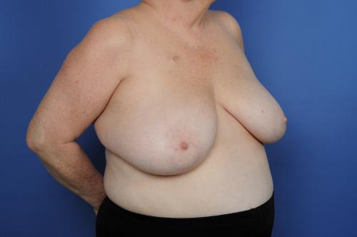 Lumpectomy Breast Reduction Before & After Image