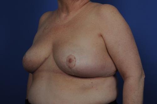 Lumpectomy Breast Reduction Before & After Image