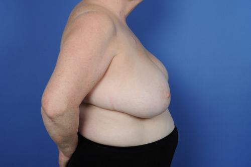 Lumpectomy Breast Reduction Before & After Image