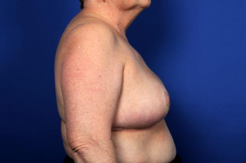 Lumpectomy Breast Reduction Before & After Image