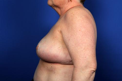 Lumpectomy Breast Reduction Before & After Image