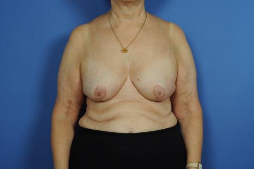 Lumpectomy Breast Reduction Before & After Image