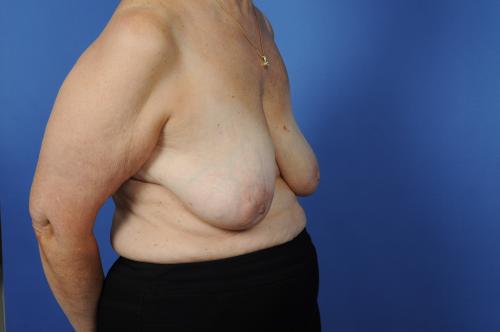 Lumpectomy Breast Reduction Before & After Image