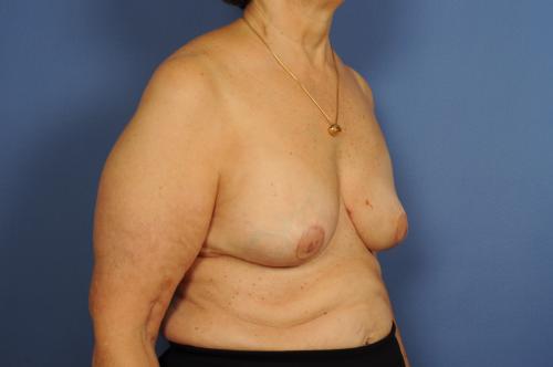 Lumpectomy Breast Reduction Before & After Image