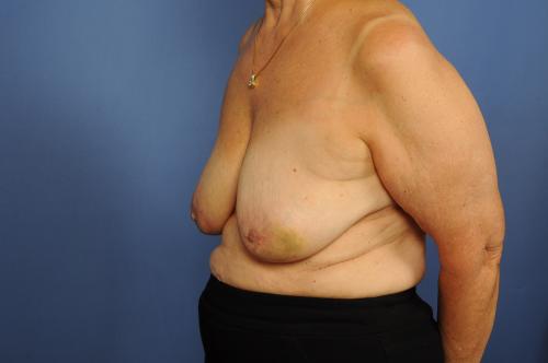 Lumpectomy Breast Reduction Before & After Image