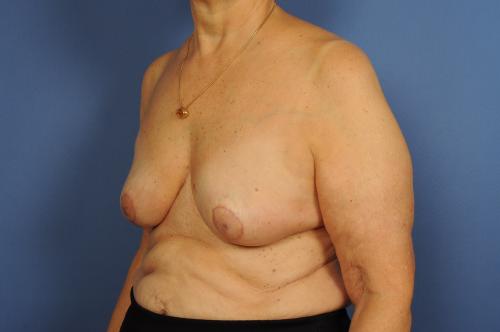 Lumpectomy Breast Reduction Before & After Image