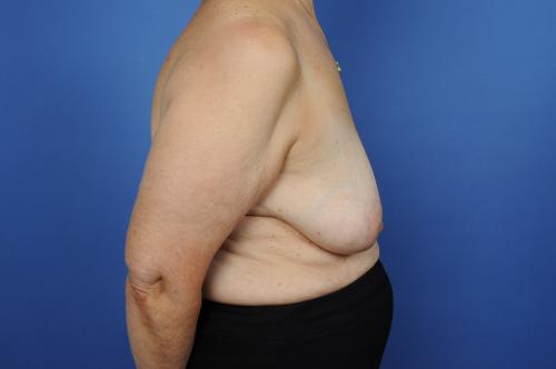 Lumpectomy Breast Reduction Before & After Image